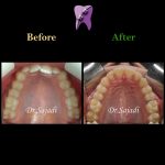 photo 2021 04 21 11 11 58 150x150 - درمان دیپ بایت با ارتودنسی ثابت و بدون کشیدن دندان