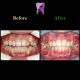photo 2021 04 24 09 35 23 80x80 - درمان دیپ بایت با ارتودنسی ثابت و بدون کشیدن دندان