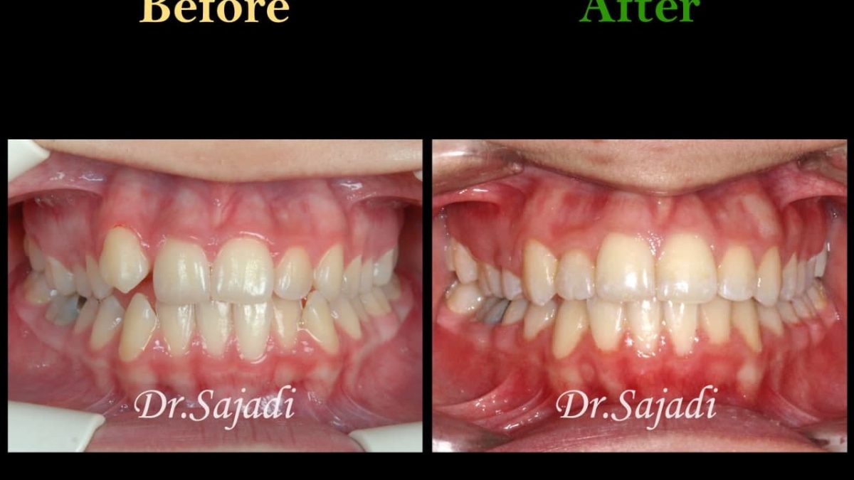 photo 2021 04 28 08 17 13 1200x675 - ارتودنسی ثابت دو فک با کشیدن یک دندان آسیای کوچک