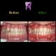 photo 2021 04 28 08 17 13 80x80 - درمان اپن بایت و بی نظمی شدید دندانی با ارتودنسی ثابت دو فک با کشیدن دندان