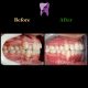 photo 2021 04 28 08 22 15 80x80 - ارتودنسی ثابت دو فک با کشیدن یک دندان آسیای کوچک