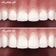 12 80x80 - با اروژن یا سایش دندان بیشتر بدانید