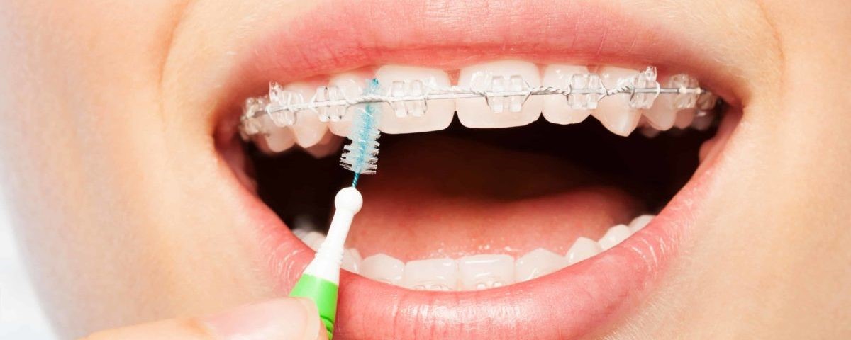 سفید کردن دندان پس از ارتودنسی