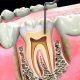 7 80x80 - هر آنچه باید در مورد روش های سفید کردن دندان ها پس از ارتودنسی بدانید