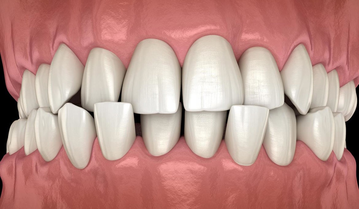 درمان شلوغی دندانها