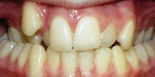 درمان شلوغی دندانها