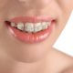 23 80x80 - درمان دندان قروچه با ارتودنسی
