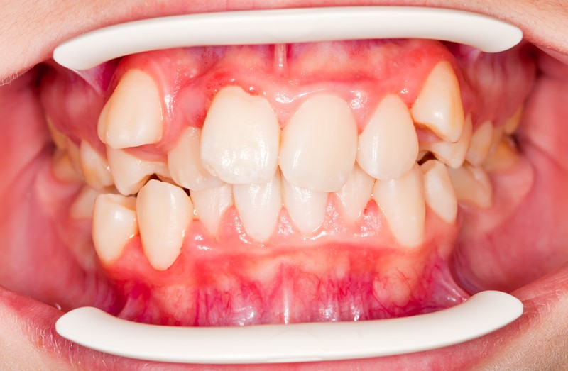 8 - با ازدحام دندان های خود چه کنیم؟
