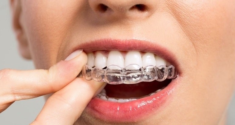 درمان دندان قروچه با ارتودنسی