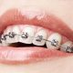 16 80x80 - درمان دندان قروچه با ارتودنسی