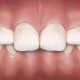 13 80x80 - بریس ها و خطر پوسیدگی و حفره های دندانی