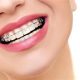 1 80x80 - بریس ها و خطر پوسیدگی و حفره های دندانی