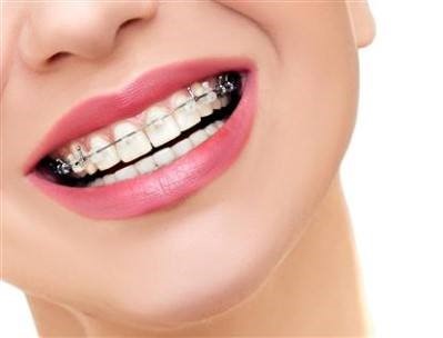 1 - بریس ها و خطر پوسیدگی و حفره های دندانی