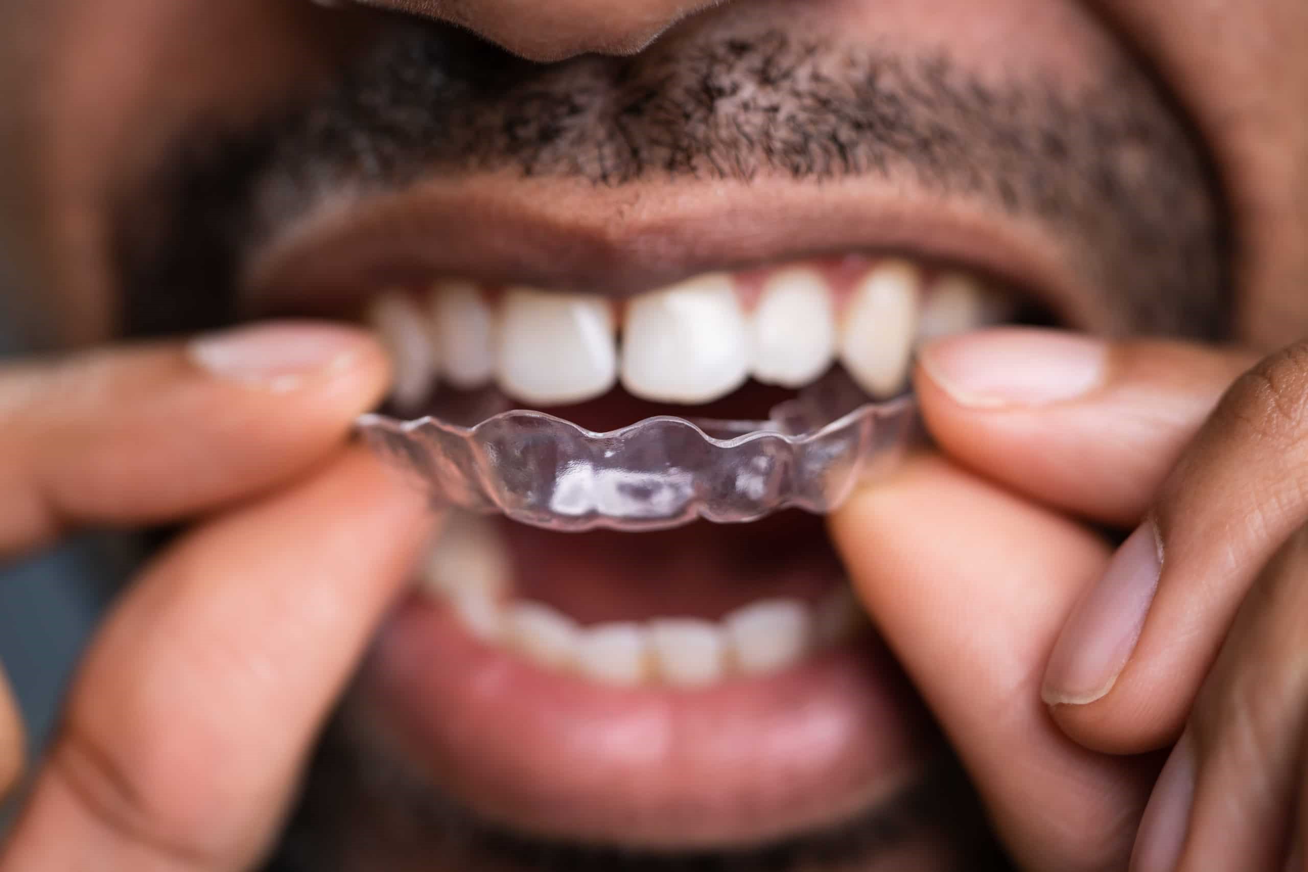 خطر  پوسیدگی دندان در ارتودنسی