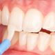 10 80x80 - دندان قروچه یا براکسیسم چیست؟