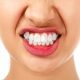 6 80x80 - دندان قروچه یا براکسیسم چیست؟
