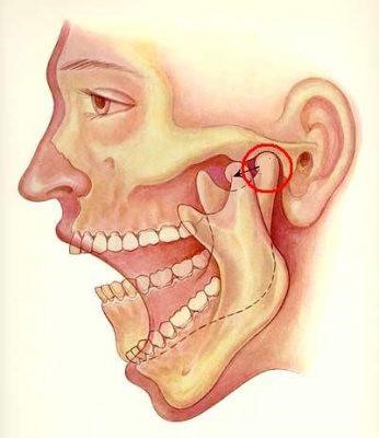 دندان قروچه یا براکسیسم