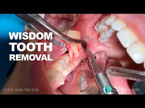 جراحی کشیدن دندان عقل