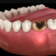 1 80x80 - آبسه دندان