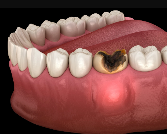 1 - آبسه دندان