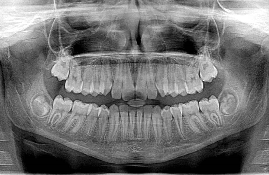 رادیوگرافی دندانپزشکی با اشعه ایکس