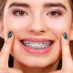 40 80x80 - دلایل زیبایی و دندانی استفاده از بریس های ارتودنسی