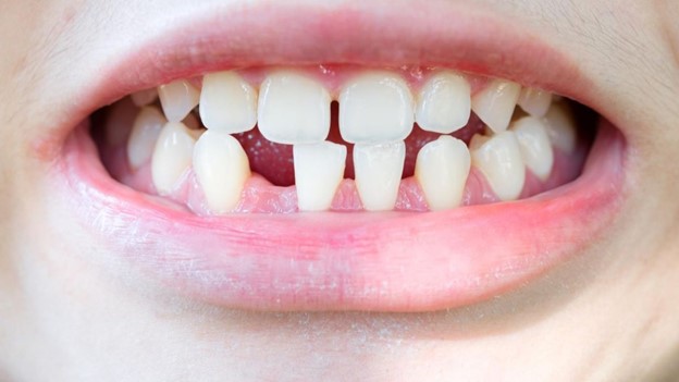 8 - هیپودنشیا یا فقدان مادرزادی دندان چیست؟