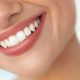 14 80x80 - باندینگ دندان چیست و چرا انجام می شود؟