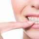 9 80x80 - دلایل زیبایی و دندانی استفاده از بریس های ارتودنسی