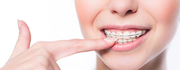 9 - دلایل زیبایی و دندانی استفاده از بریس های ارتودنسی