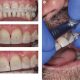 8 80x80 - تراش مینای بین دندانی یا اینترپروکسیمال در ارتودنسی
