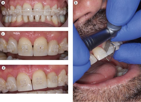 8 - تراش مینای بین دندانی یا اینترپروکسیمال در ارتودنسی