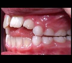 تانگ تراست یا فشار دادن زبان به پشت دندان