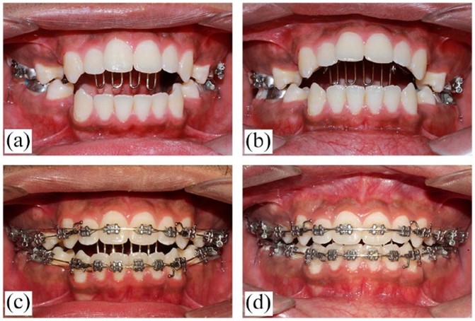تانگ تراست یا فشار دادن زبان به پشت دندان