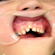 1 80x80 - اگر کودک دندان انکیلوز داشته باشد به چه معناست؟
