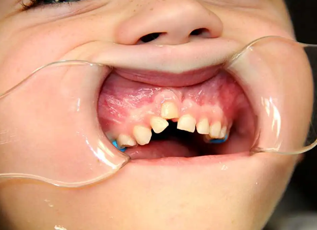 1 - اگر کودک دندان انکیلوز داشته باشد به چه معناست؟