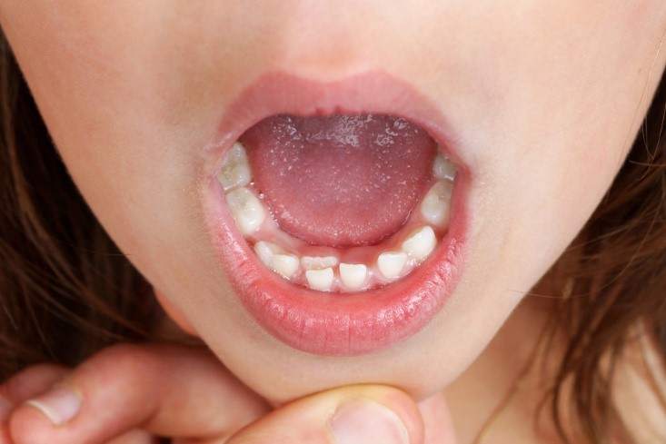  دندان فک جوش در کودکان