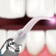 1 1 80x80 - کاربردهای لیزرهای دندانپزشکی در درمان ارتودنسی