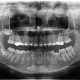 16 80x80 - بریس های ارتودنسی تنها روی دندان های یک فک: آری یا خیر؟