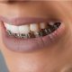 9 80x80 - بریس های ارتودنسی تنها روی دندان های یک فک: آری یا خیر؟