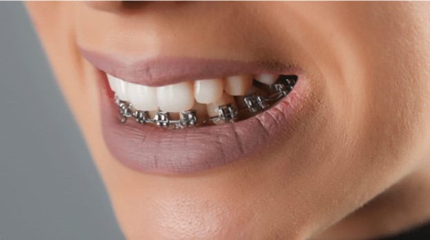 9 - بریس های ارتودنسی تنها روی دندان های یک فک: آری یا خیر؟
