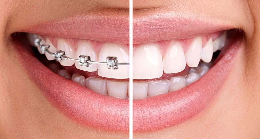 0 min 1 - چگونه هنگام استفاده از بریس، دندان ها را سفید نگه داریم؟