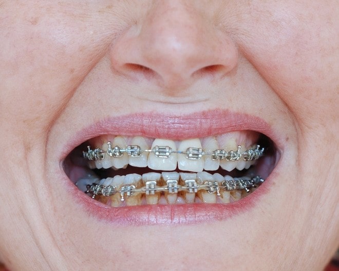 دندان های سفید با بریس ها