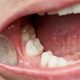 0 min 1 80x80 - چگونه می توان از سرعت تحلیل استخوان در دندان ها کاست؟
