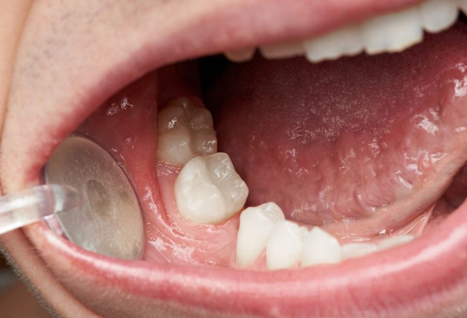 0 min 1 960x653 - چگونه می توان از سرعت تحلیل استخوان در دندان ها کاست؟