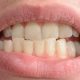1 min 80x80 - علل جابجایی ناگهانی دندان ها