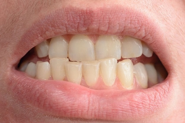 1 min - علل جابجایی ناگهانی دندان ها