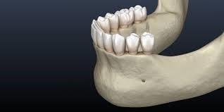 درمان تحلیل استخوان در دندان