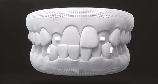 علت زرد شدن دندان ها با الاینرهای ارتودنسی نامرئی