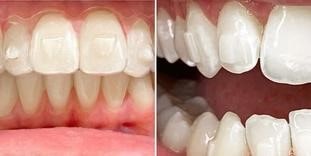 در مورد زردی دندان ها ناشی از الاینرهای شفاف چه باید کرد؟